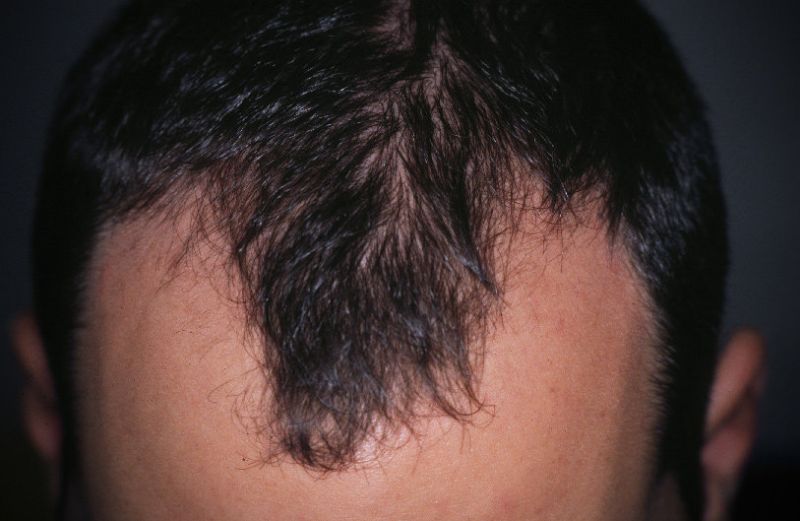 alopecia-androgenetica_800x521
